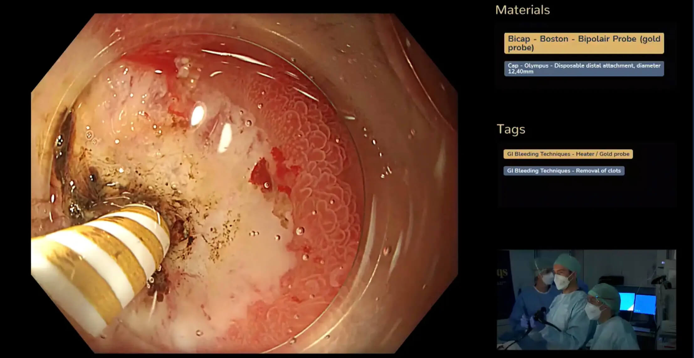 Heater probe use to treat a visible vessel in a duodenal ulcer